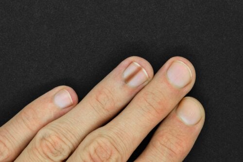 Melanonychia paznokcia: przyczyny i sposoby leczenia