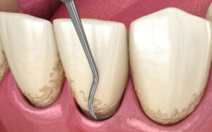 Kiretaż dentystyczny: procedura, efekty i pielęgnacja